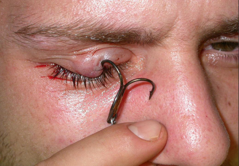 fishhook in eye