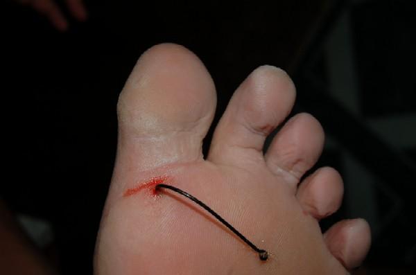 fishhook in foot