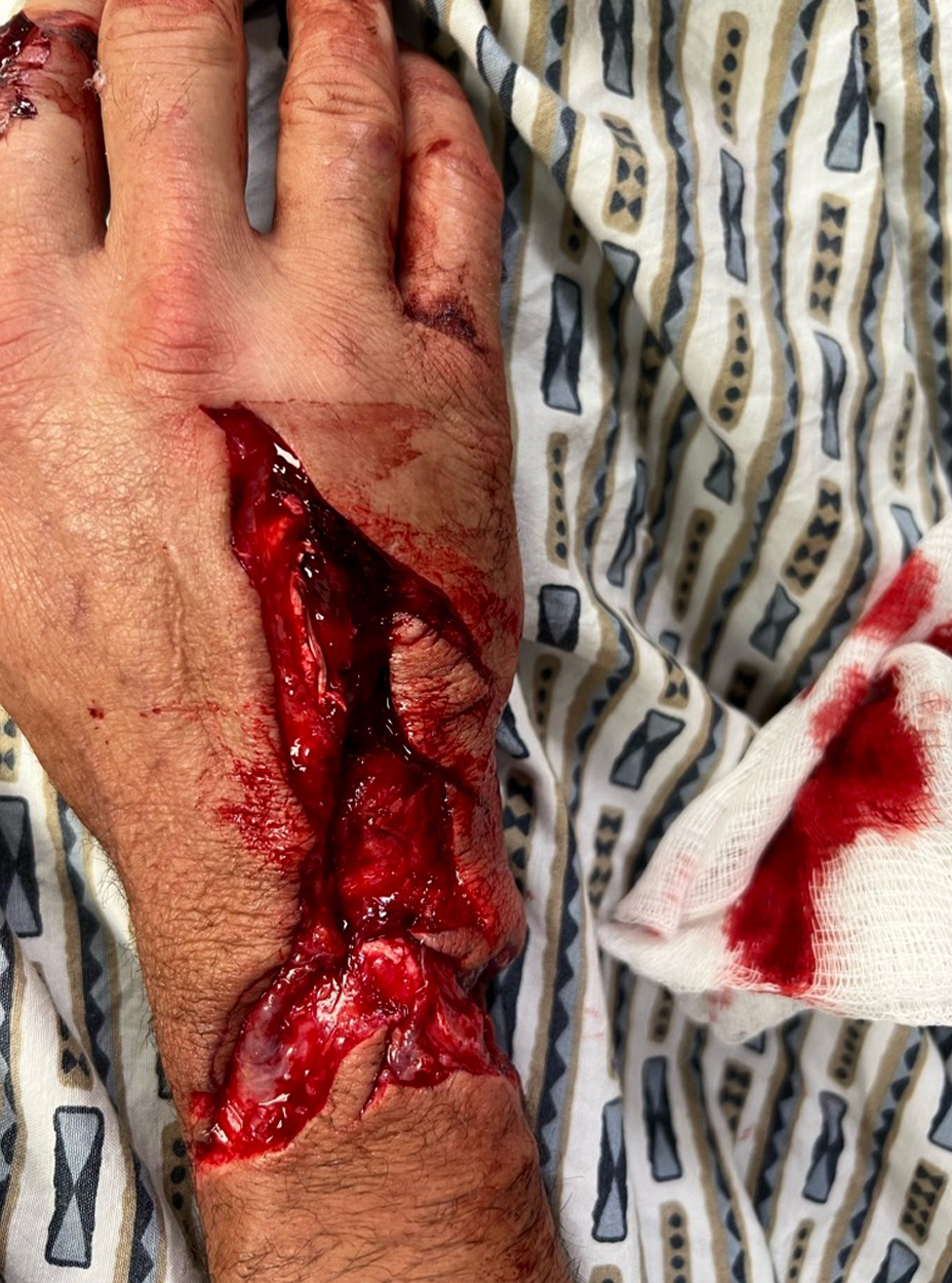 Hand injury caused by shark attack.