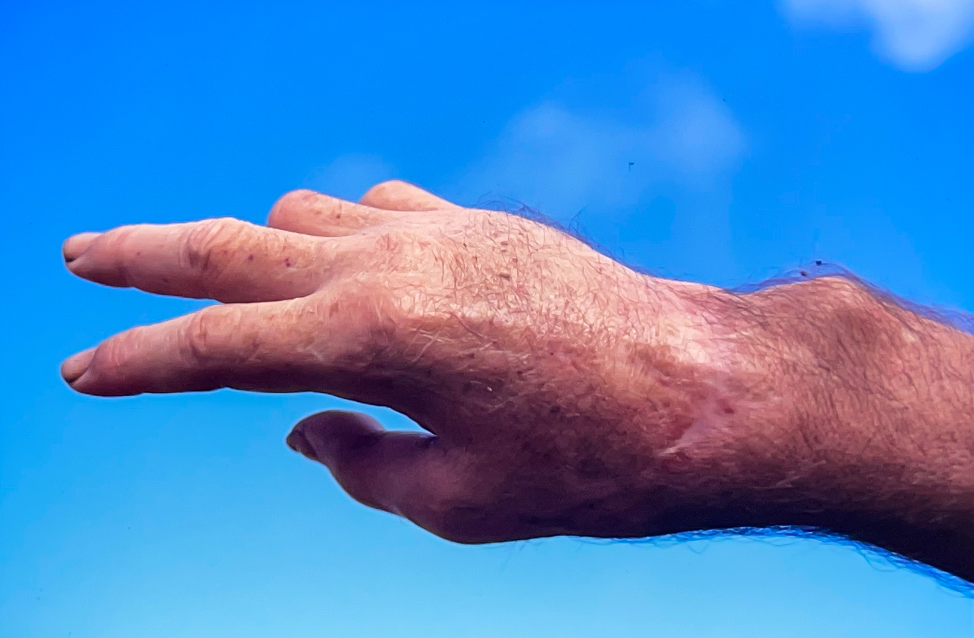 A man's hand was bitten off by a saltwater croc and reattached.